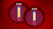 PRP and PRF tubes used for regenerative therapy – blood collection tubes with ACD-Gel, available from Charles Medical UK