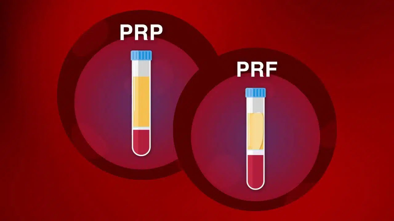 PRP and PRF tubes used for regenerative therapy – blood collection tubes with ACD-Gel, available from Charles Medical UK