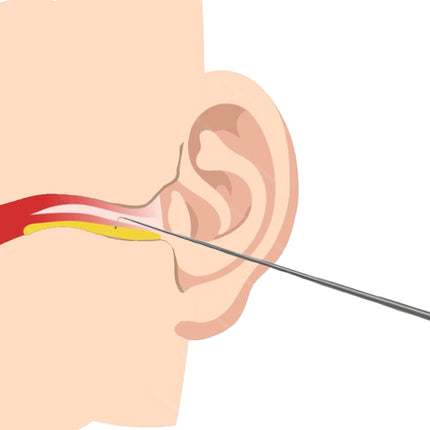 ENT specialist using St Barts hook for earwax removal, cerumen extraction procedure